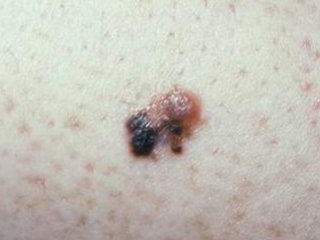 Melanoma